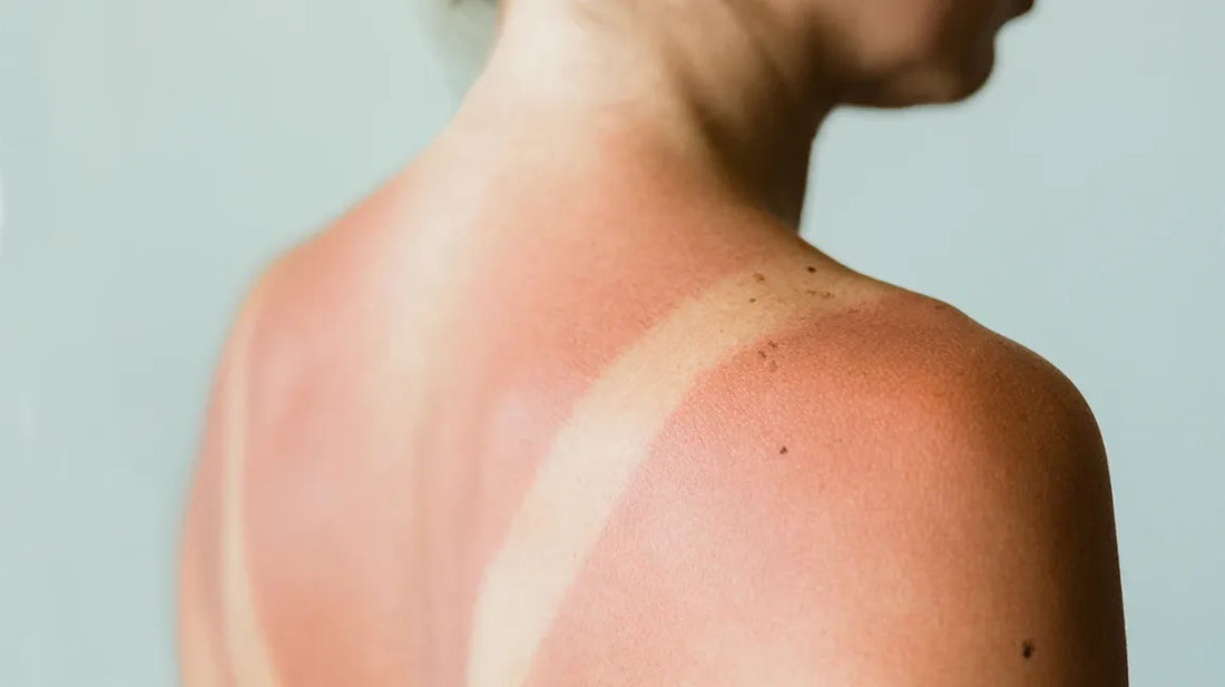 Ayurvedic Remedies for Sunburn